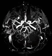 МРТ артерий головного мозга