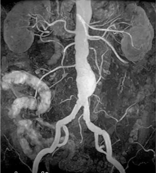 Компьютерная ангиография брюшного отдела аорты и ее ветвей