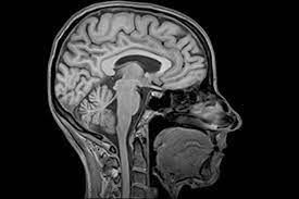 МРТ гипофиза головного мозга