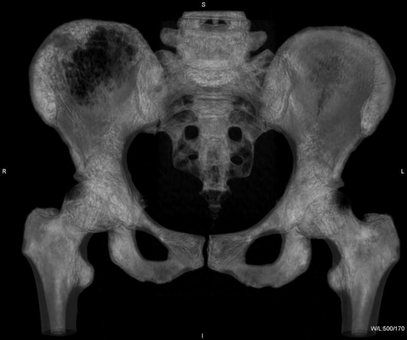 Компьютерная томография костей (одна область)