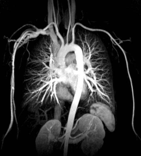 Компьютерная ангиография грудного отдела аорты и ее ветвей
