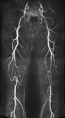 Компьютерная ангиография артерий нижних конечностей