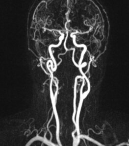МРТ артерий шеи