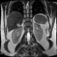МРТ брюшной полости (печень, желчевыводящие пути, поджелудочная железа, селезенка) и холангиография