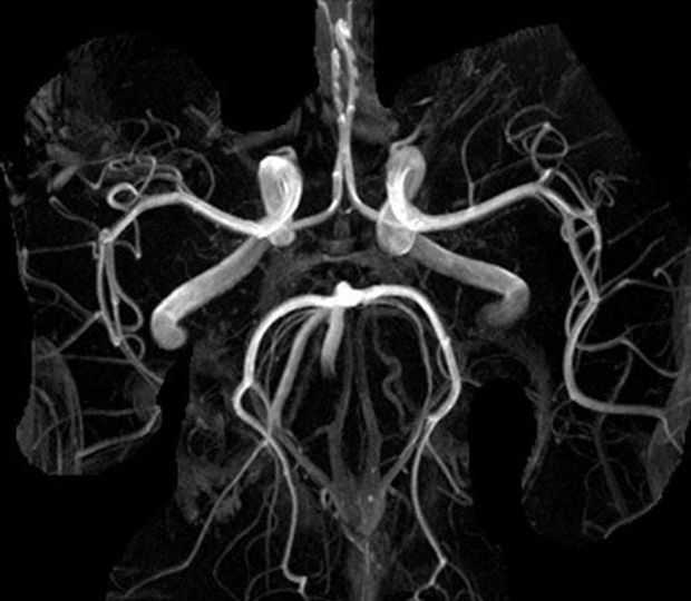Компьютерная ангиография артерий головного мозга