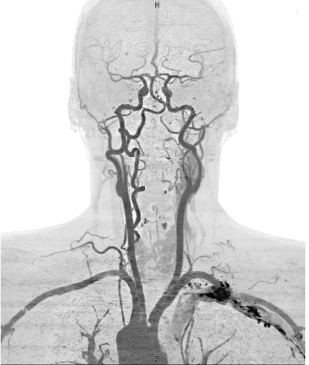 Компьютерная ангиография артерий шеи